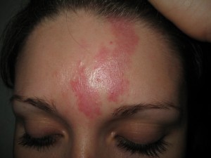 Hämangiom vor der Behandlung