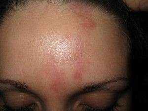 Hämangiom nach zwei Behandlungen