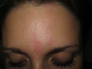 Hämangiom nach vier Behandlungen