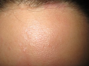 Hämangiom nach sechs Behandlungen