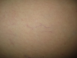 Varice superficiale 1