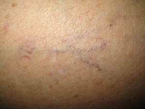 Varice superficiale 3