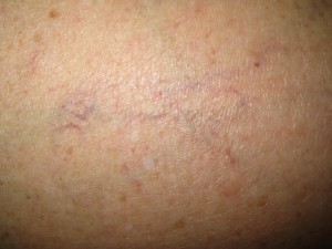 Varice superficiale 4