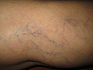 Varice superficiale 5