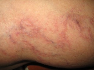 Varice superficiale 6