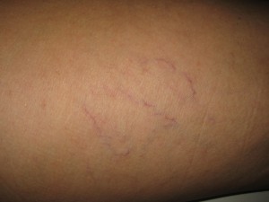 Varice superficiale 7