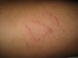 Varice superficiale 8